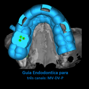 GUIA ENDODONTICA (ENDOGUIDE) BROCAS EG DSM PARA ACESSO A 3 CANAIS CALCIFICADOS