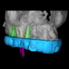 GUIA ENDODONTICA (ENDOGUIDE) BROCAS EG DSM PARA ACESSO A 3 CANAIS CALCIFICADOS - Imagem 2