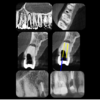 GUIA ENDODONTICA (ENDOGUIDE) BROCAS EG DSM PARA ACESSO A 2 CANAIS CALCIFICADOS - Imagem 3
