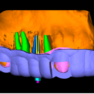 GUIA ENDODONTICA (ENDOGUIDE) BROCAS EG DSM PARA ACESSO A 2 CANAIS CALCIFICADOS