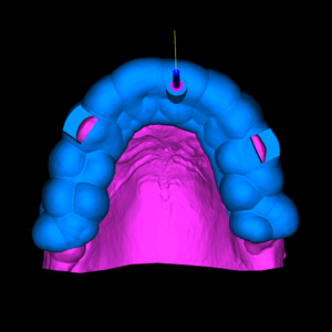 GUIA ENDODONTICA (ENDOGUIDE) BROCAS EG DSM PARA ACESSO A 1 CANAl CALCIFICADO