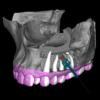 GUIA PARA CIRURGIA PARENDODÔNTICA (MICROCIRURGIA APICAL) - Imagem 4