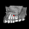 GUIA PARA CIRURGIA PARENDODÔNTICA (MICROCIRURGIA APICAL) - Imagem 6