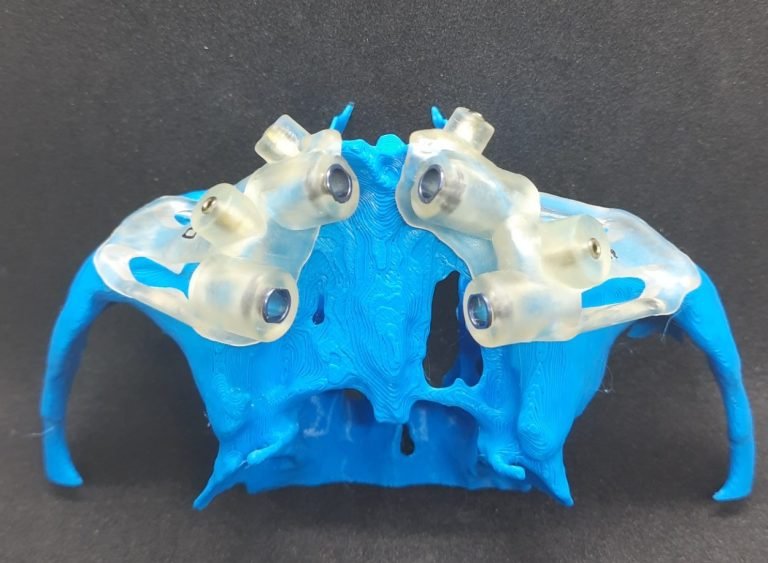 GUIA CIRURGICO ZIGOMATICO PARA 4 IMPLANTES